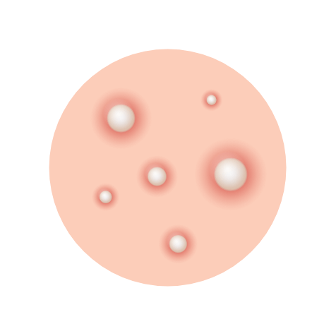 白ニキビの図