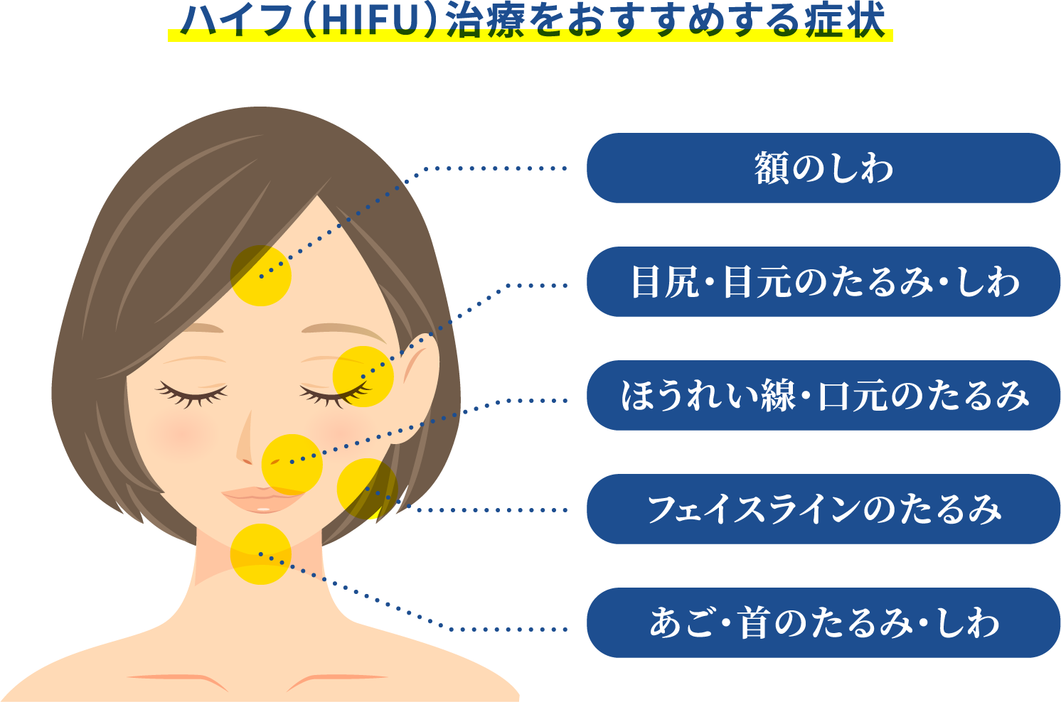 ハイフ（HIFU）治療をお勧めする症状　額のしわ　目尻・目元のたるみ・しわ　ほうれい線・口元のたるみ　フェイスラインのたるみ　あご・首のたるみ・しわ